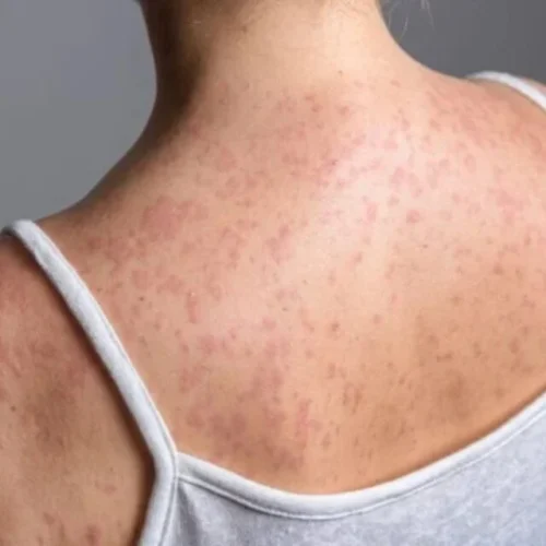 Minnesota reporta 10 casos de sarampión en lo que va de 2026