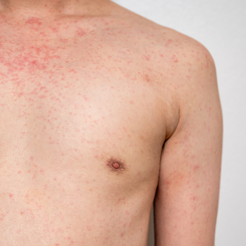 Autoridades alertan por posible exposición a sarampión en el Mall of America